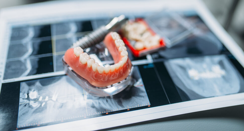 Why Dentures Keep Breaking: The Hidden Causes